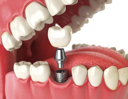 Implantes Dentales